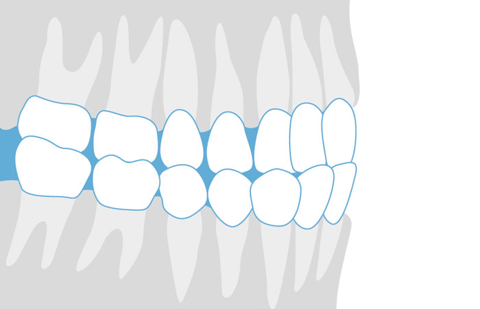 Mandíbula estalando ao abrir e fechar a boca pode ser sinal de disfunção na  ATM (Disfunção Temporomandibular) - Hospital da Face