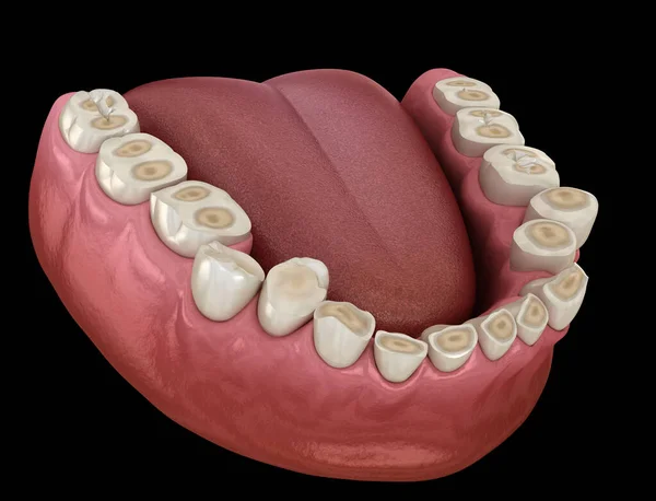 Bruxismo do sono - saiba como evitar as dores e desgastes dos dentes