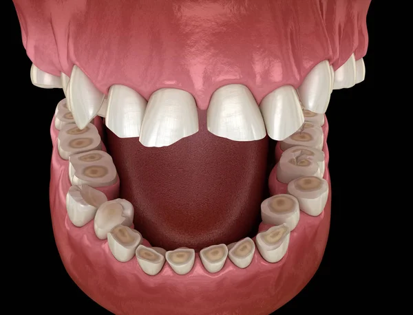 Mandíbula estalando ao abrir e fechar a boca pode ser sinal de disfunção na  ATM (Disfunção Temporomandibular) - Hospital da Face