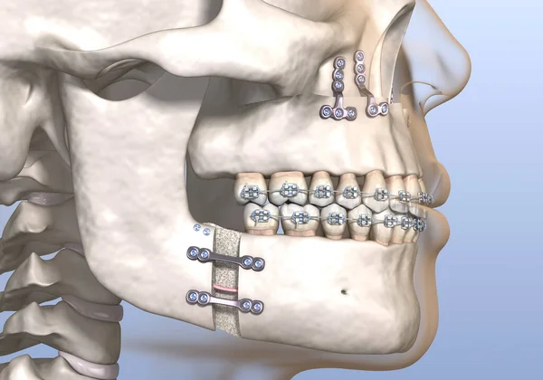 Mandíbula estalando ao abrir e fechar a boca pode ser sinal de disfunção na  ATM (Disfunção Temporomandibular) - Hospital da Face