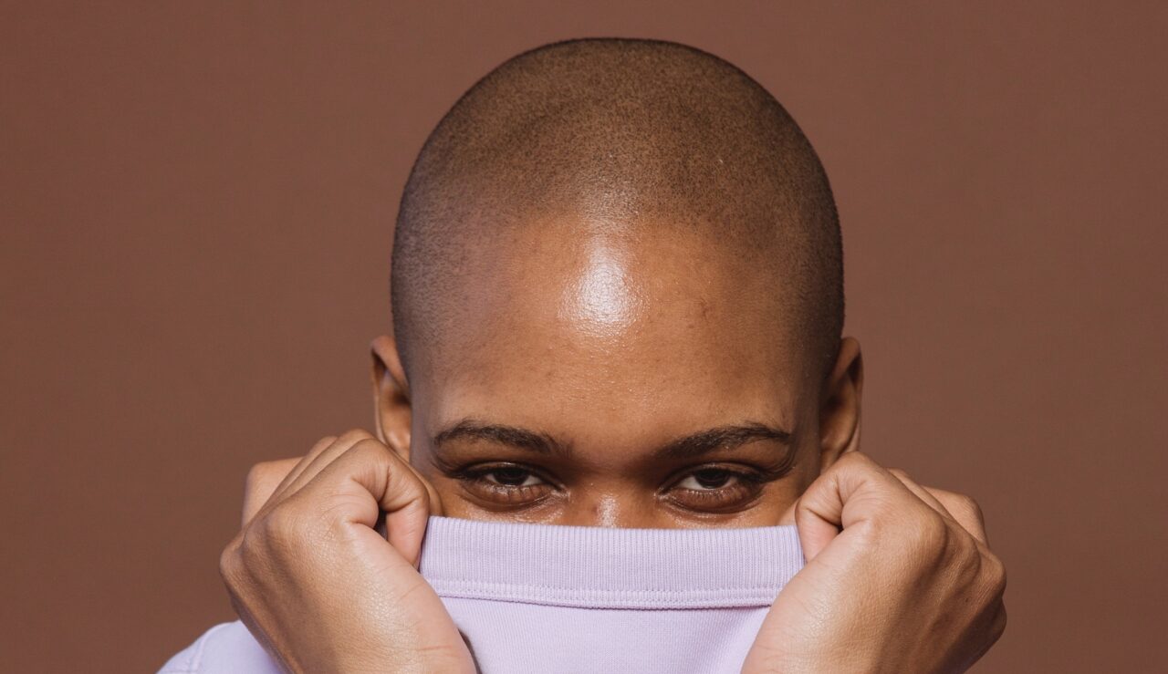 O que é calvície ou alopecia androgenética?