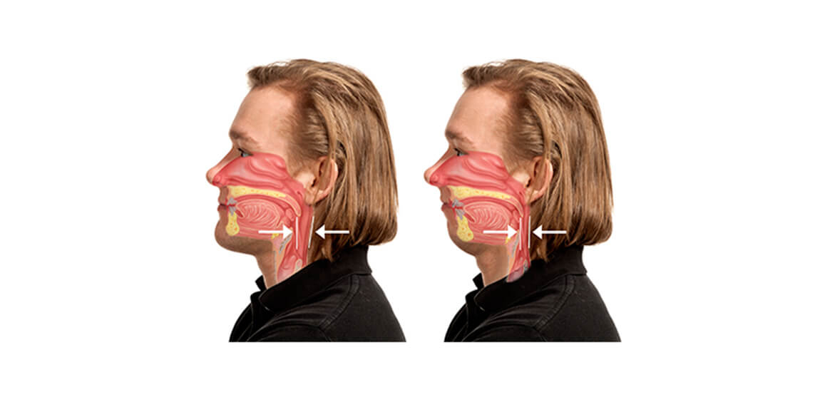 Retrognatismo e Apneia do Sono: Uma Conexão Perigosa que Pode Estar Afetando sua Saúde